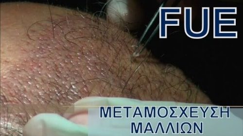 Ενημερωτικά Βίντεο Για Την Πλαστική Χειρουργική