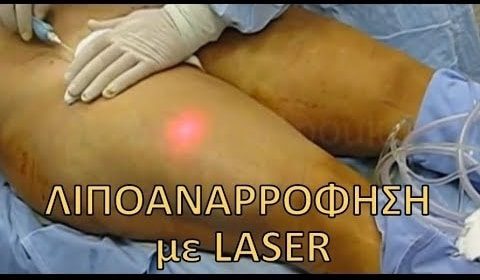 λιποαναρρόφηση με λέιζερ laser lipolysis slim lipo