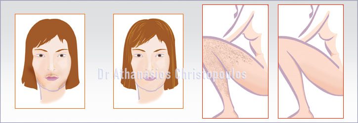 Αποτρίχωση με λέιζερ σε μπικίνι - πρόσωπο - μασχάλες | Αντιμετώπιση ανεπιθύμητης τριχοφυίας | Aesthetics Anaplasis
