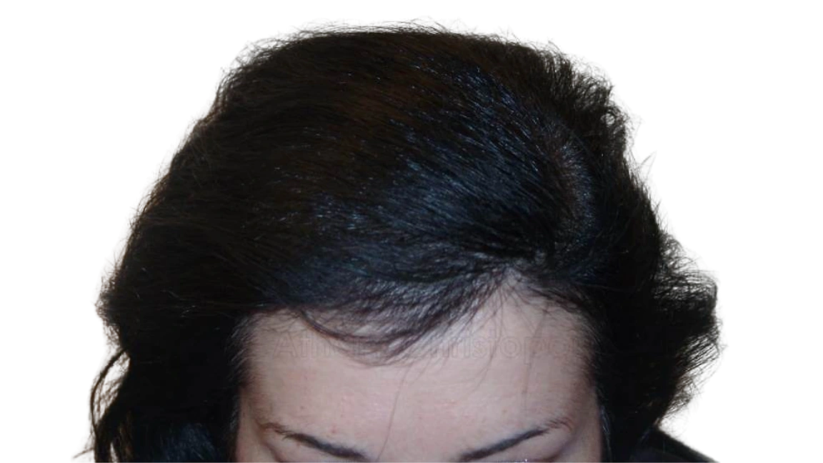 After-Μεταμόσχευση μαλλιών