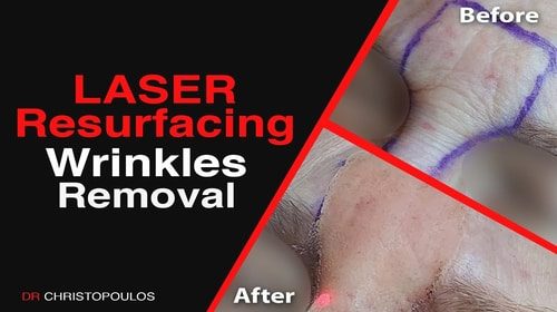 Laser Resurfacing for wrinkle removal