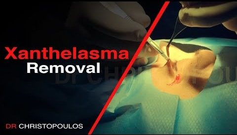 Πλαστική χειρουργική αφαίρεση ξανθελασμάτων