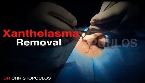 Χειρουργική Αφαίρεση ξανθελάσματος