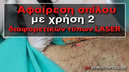 Αφαίρεση σπίλου με χρήση 2 διαφορετικών τύπων LASER