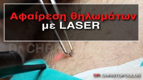 Αφαίρεση θηλωμάτων με LASER