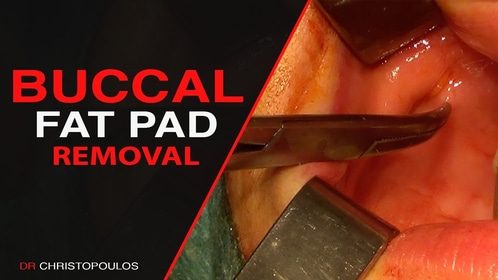 buccal fat pad removal