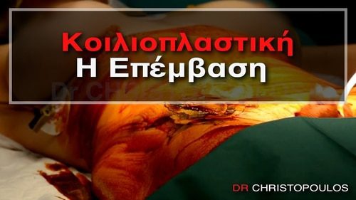 Κοιλιοπλαστική