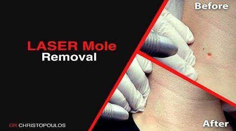mole laser removal