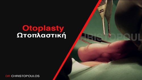 Ωτοπλαστική