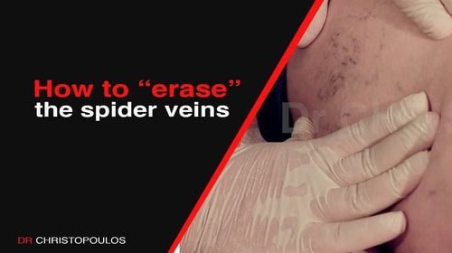Spider veins removal by LASER or Scherotherapy